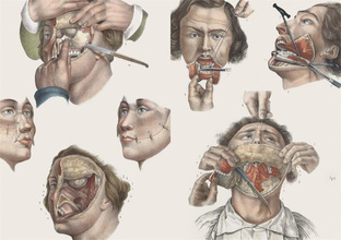 Crucial Interventions : Nineteenth Century Surgery